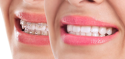 The image shows a close-up of a person s face with two smiles, showcasing dental braces and lipstick.