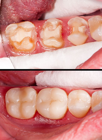 The image displays a close-up view of a mouth with decayed teeth and gum disease, showcasing oral health issues.