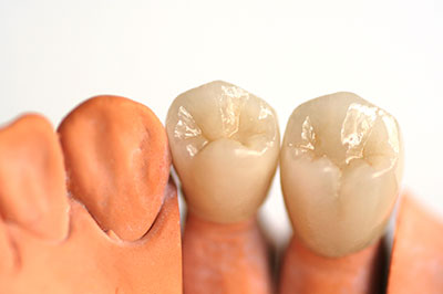 The image shows a close-up of two artificial teeth with visible dental implants, set against a white background.