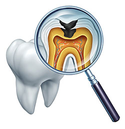 The image shows a magnified view of a tooth with an X-ray inside it, revealing internal dental structures such as roots and pulp chamber, with a focus on the cavity area where bacteria are visible.