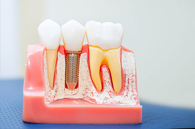 The image shows a dental model with various teeth and tooth structures, including a tooth with a hole filled by a screw and another with a yellow filling, set against a blue background.