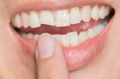 The image shows a close-up of a person s teeth with a focus on a gap between two front teeth, and there is a hand holding a finger up against the mouth.