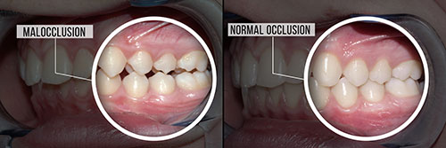 The image shows four photos of a person s teeth with annotations highlighting different dental procedures, including malocclusion and tooth decay.
