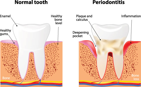 The image presents two stages of tooth decay progression  normal and advanced, with accompanying text explaining the differences between them.
