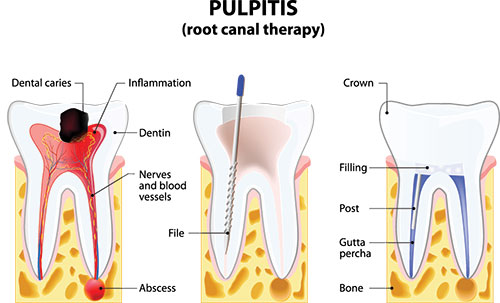 The image shows a graphic illustration of a tooth with annotations detailing the structure and parts of a human tooth, including labels such as  pulp,   root canal therapy,   crown,  and  dental caries.