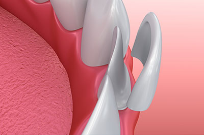 The image shows a close-up view of a dental implant with an abutment in place, set against a red background.