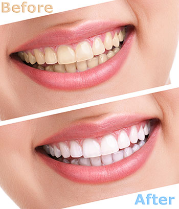 The image shows a before-and-after comparison of teeth whitening, featuring a person s smile with yellowed teeth on the left and a brighter, whiter smile on the right after treatment, with text indicating  before  and  after  stages.