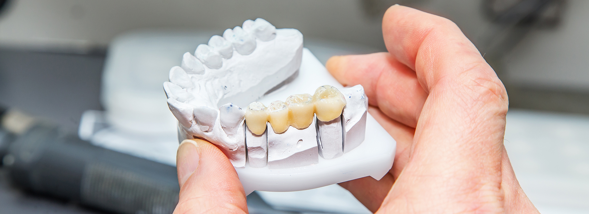 A person holding a 3D printed dental model with missing teeth.