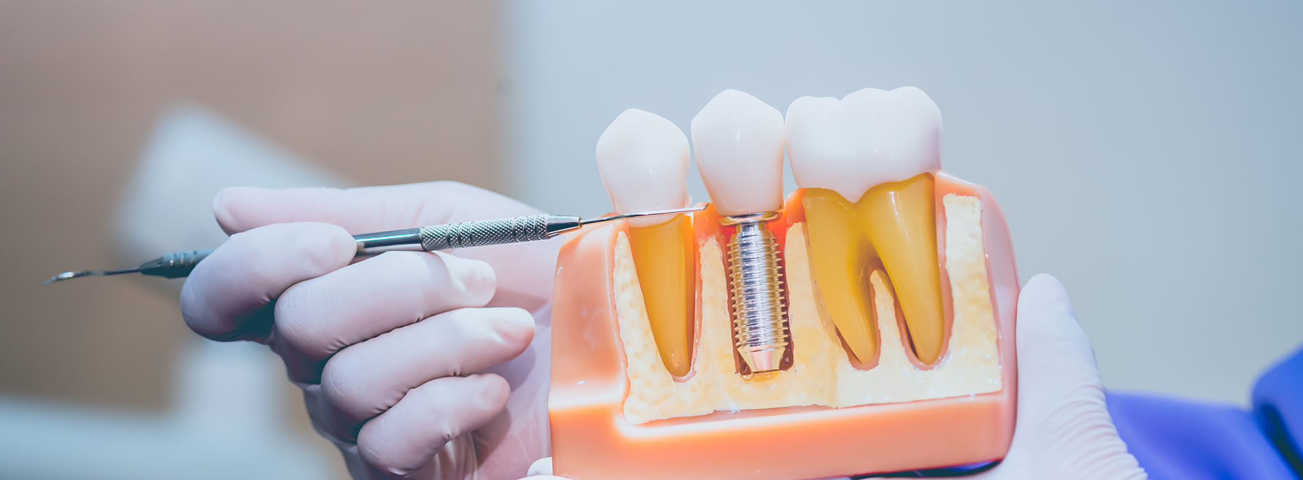 The image shows a close-up of a person s hands working on dental implants with tools and a tray containing screws, set against a blurred background that appears to be a medical or dental office.