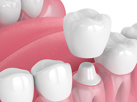 A digital illustration showcasing a collection of dental implants with varying shades of pink and white, designed to mimic the appearance of gum tissue and teeth.