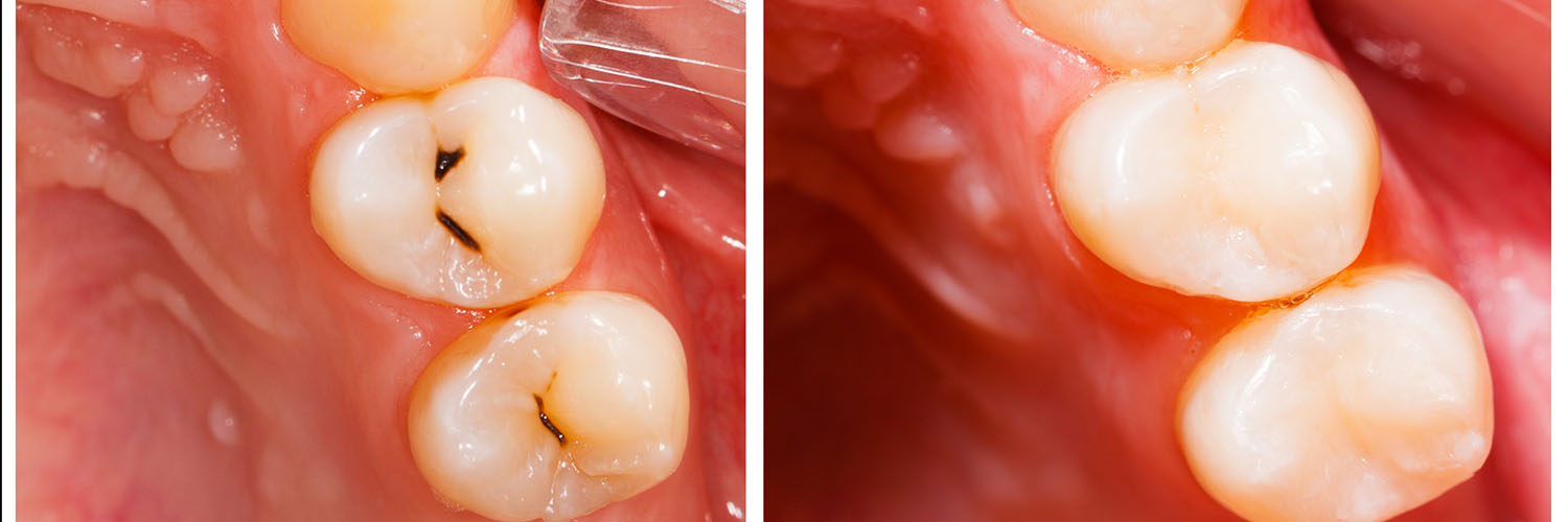 The image shows a close-up view of a human mouth with teeth and gums, highlighting dental health and oral hygiene.