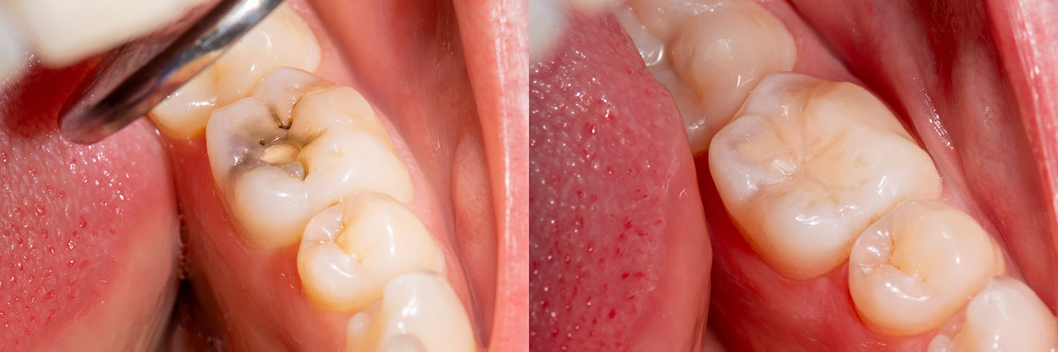 The image shows a close-up view of a human mouth with teeth, gums, and tongue, featuring an upper denture with visible wear and tear, and a lower set of teeth with some missing, possibly due to decay or extraction.